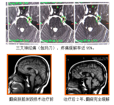 神经外科-伽玛刀科(图11)