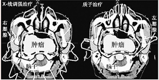 复发鼻咽癌的质子放射治疗(图1)