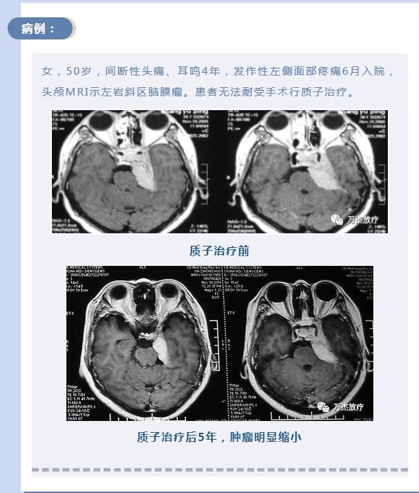 颅内脑膜瘤的质子治疗